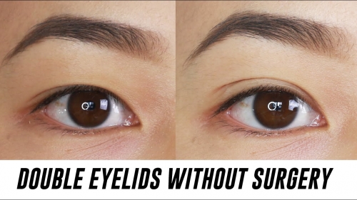 Eyelid Surgery Singapore